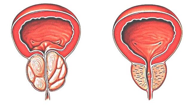 Prostatitida a normální prostata