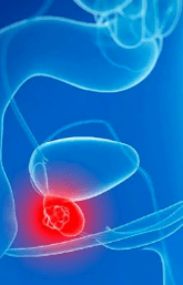 Prostatitida