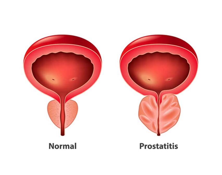 normální a zánětlivá prostata