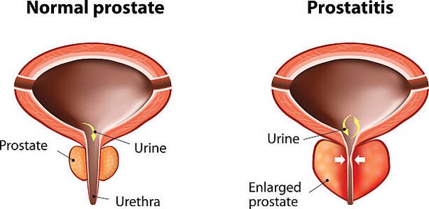 Normální a zanícená prostata